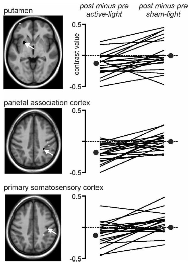 Individual participant brain activation under active and sham light