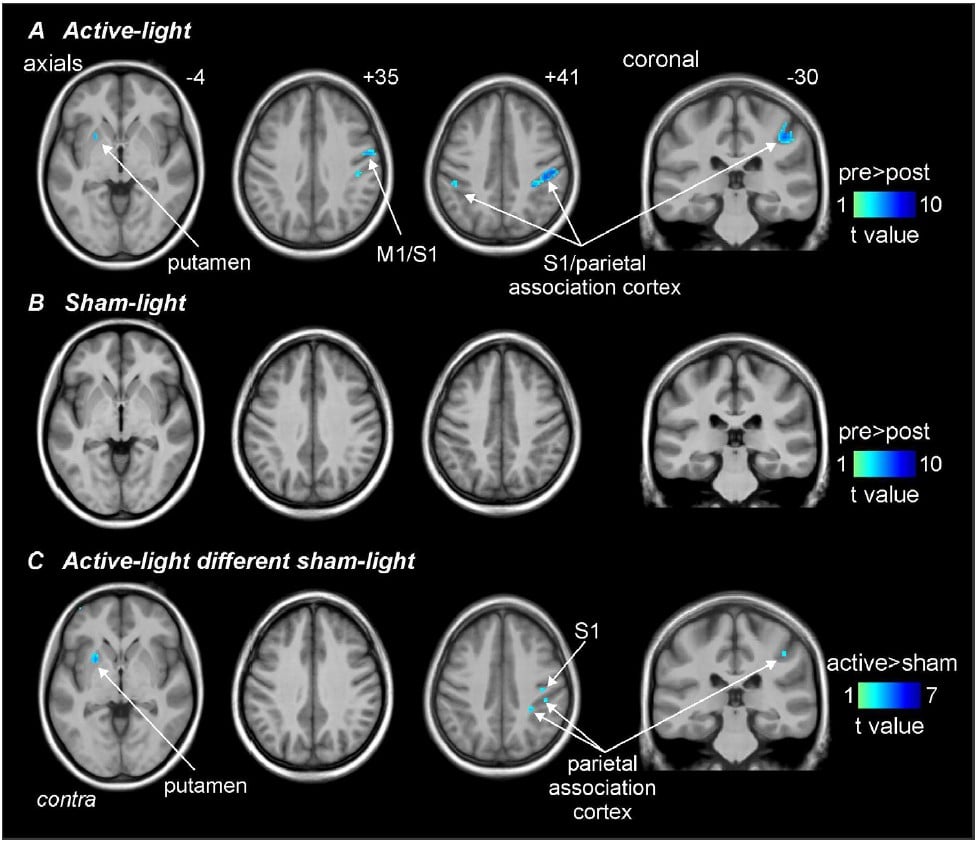 Using Magnetic Resonance Imaging to Explore the Effects of the Vielight ...