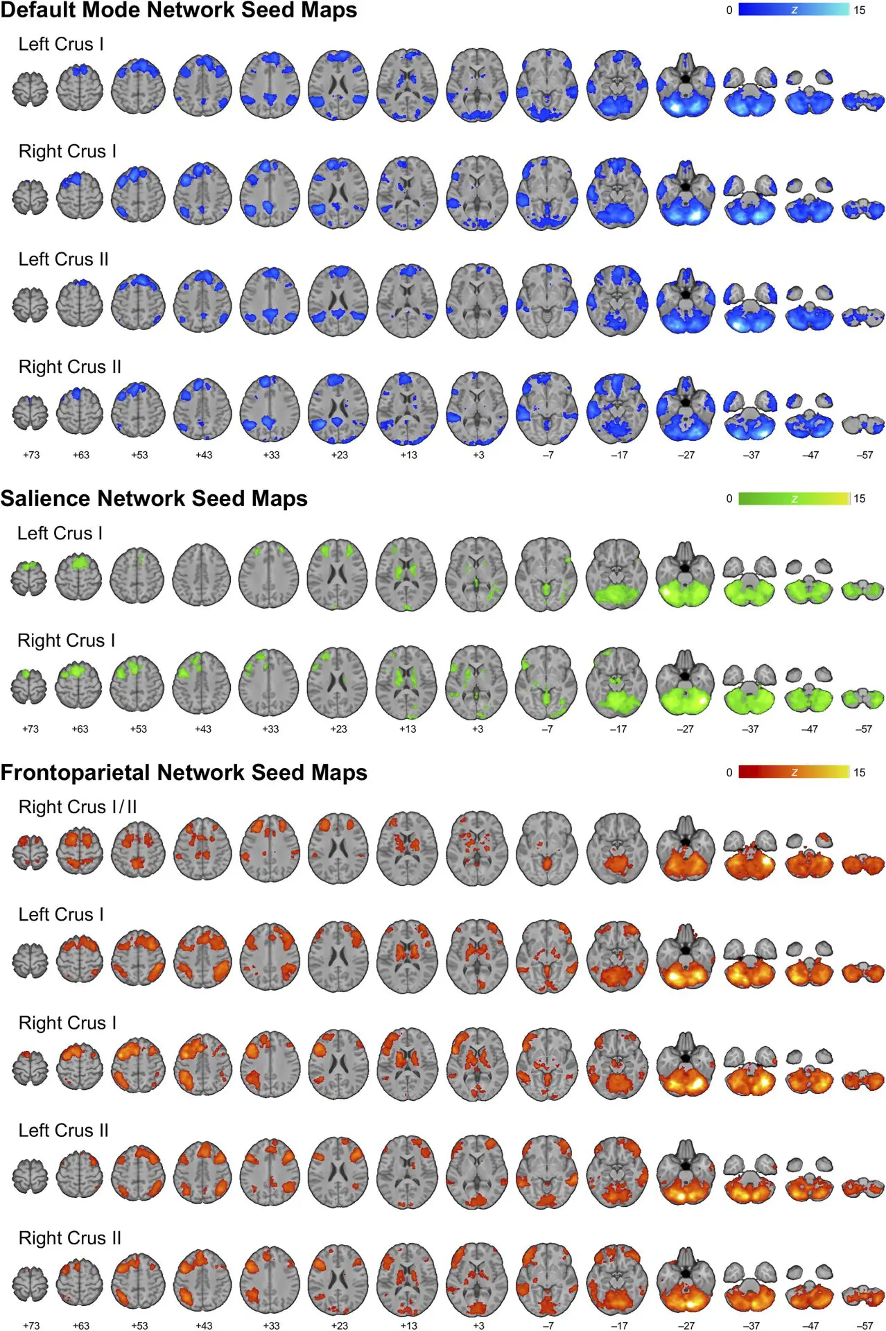 TBI Clinical Results: Cerebellar Network Efficiency with the