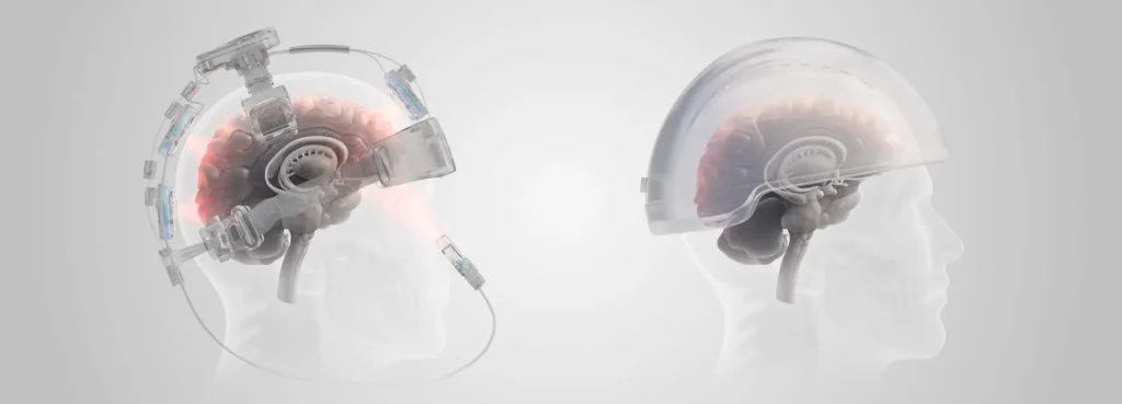 Comparison of transcranial helmet coverage against Vielight intranasal and transcranial delivery